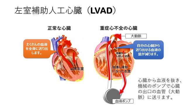 左室補助人工心臓（LVAD）