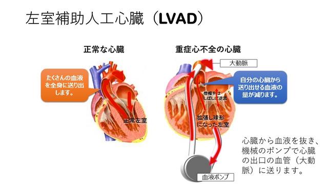 左室補助人工心臓(LVAD)