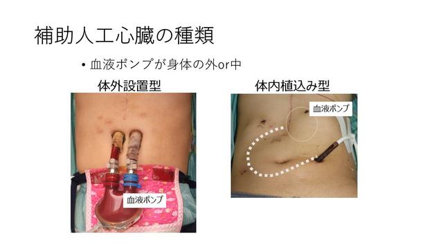 補助人工心臓の種類:体外設置型と体内植込み型