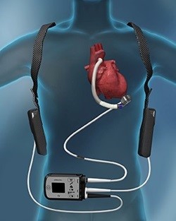 補助人工心臓（VAD）