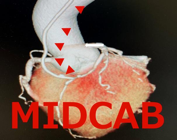 MIDCAB 低侵襲冠動脈バイパス手術